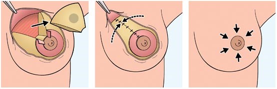 جراحی با حفط پستان