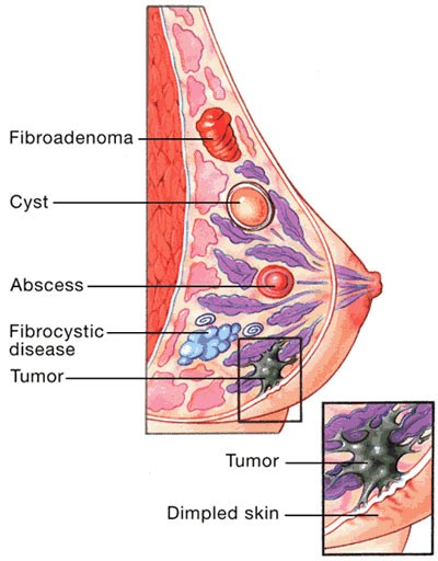 تومور بدخیم پستان