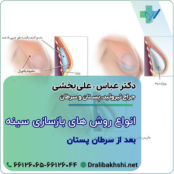 انواع روش های بازسازی سینه بعد از سرطان پستان