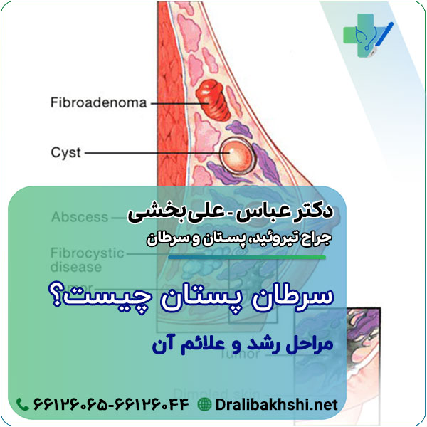 سرطان پستان چیست؟ مراحل رشد و علائم آن+خودآزمایی