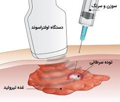 اسکن تیروئید