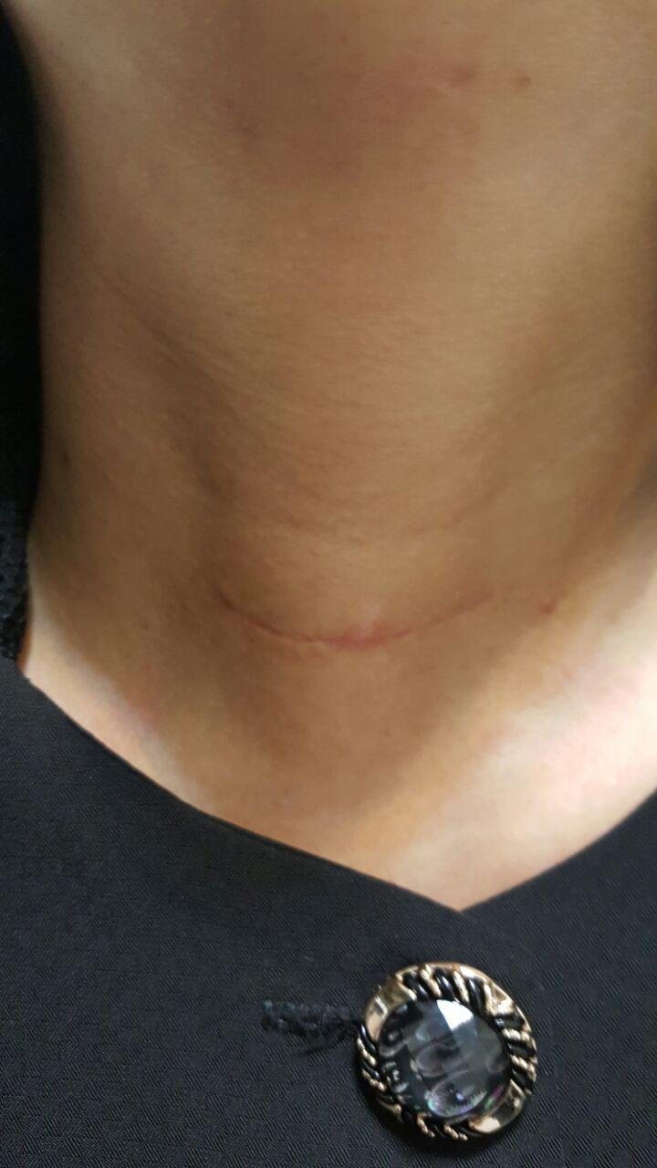 برش تیروئید