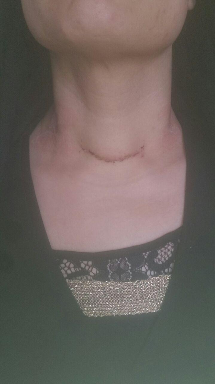 برش تیروئید