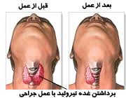 شماتیک قبل و بعد از جراحی تیروئید