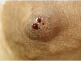 عکس ترشح خونی نوک پستان