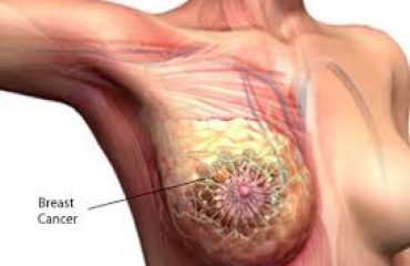 شماتیک سرطان پستان