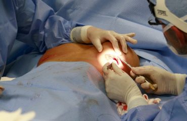 جراحی سرطان سینه در تهران