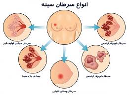 انواع سرطان پستان