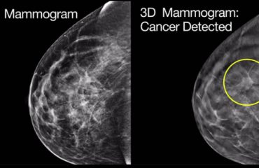 عکس از ماموگرافی