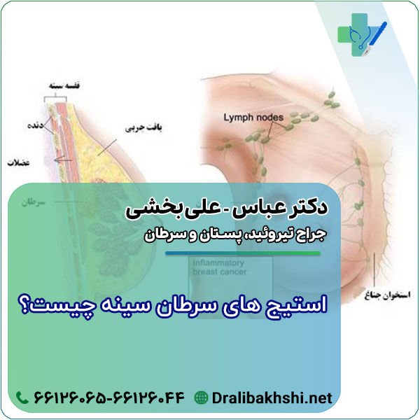 استیج های سرطان سینه چیست؟