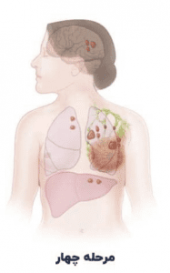 مرحله چهارم سرطان پستان