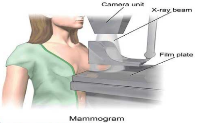 ماموگرافی سرطان سینه