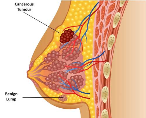 توده در سینه جراح سرطان پستان