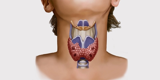 گره تیروئید بزرگی تیروئید در گردن