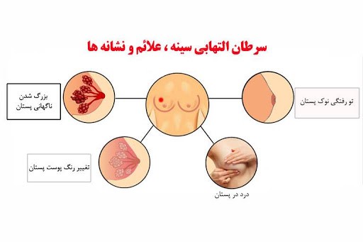 علائم سرطان سینه از نظر بهترین متخصص سرطان سینه | دکتر علی بخشی