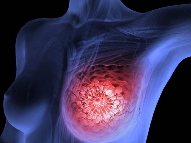 تشخیص تومور پستانی