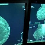 ماموگرافی تشخیص سرطان سینه