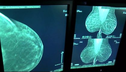 ماموگرافی تشخیص سرطان سینه