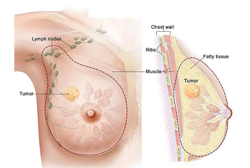 جراح سرطان پستان