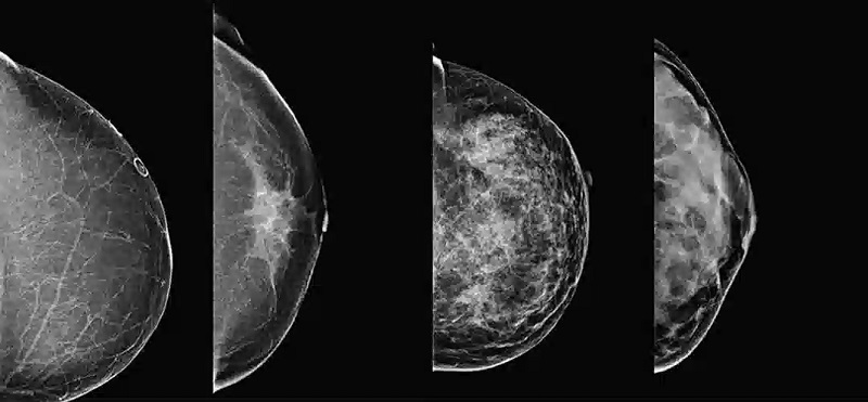 غربالگری سرطان سینه جهت تشخیص توده